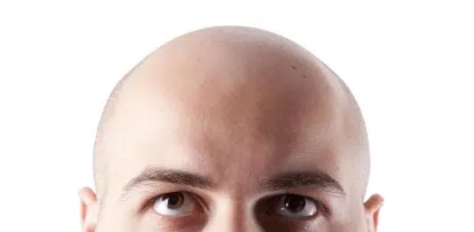 Est-ce que les cheveux fins peuvent mener à une calvitie ?