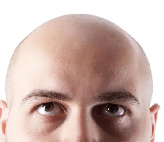 Est-ce que les cheveux fins peuvent mener à une calvitie ?