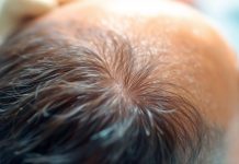 Quels sont les derniers progrès en matière de techniques de greffe capillaire ?