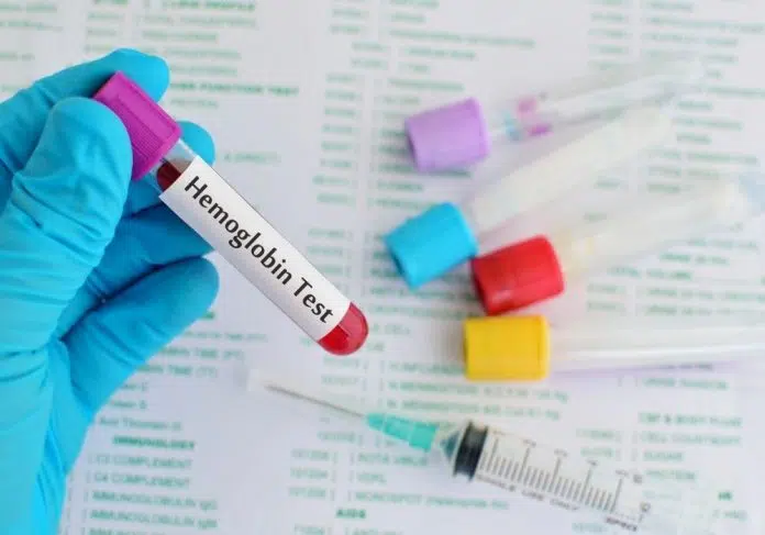 Hémoglobine glyquée ou glycosylée (HbA1C) norme