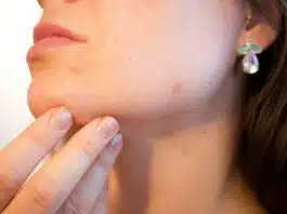 boutons remplis de sang