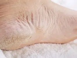 Comment soigner une crevasse sous le talon ?